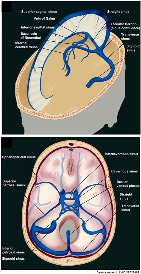 Cavernous Sinus Thrombosis Mrv