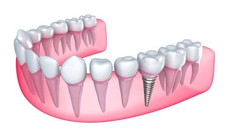 What is a Single Tooth Implant? — DFW Implant Team ┃ Donald Steinberg, DDS