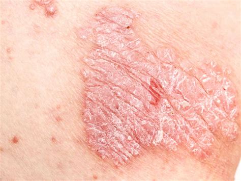 Genital psoriasis: Symptoms, treatment, and causes