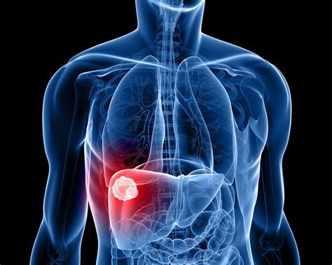 Liver Cancer Types And Stages