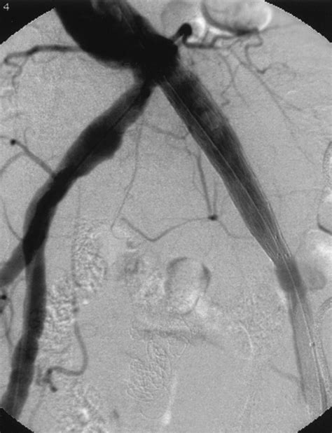 Endovascular Treatment of Iliac Artery Aneurysms | RadioGraphics