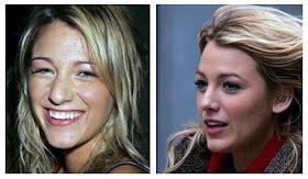 Plastic Surgery Before And After: Blake Lively Plastic Surgery