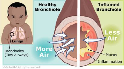 How To Prevent Bronchiolitis - Killexhibition Doralutz