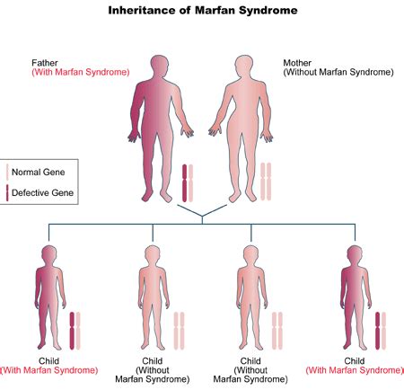 Marfan Syndrome - Physiopedia