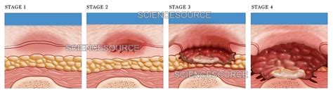 Photograph | Progression of Pressure Sore | Science Source Images