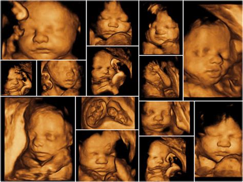 3D & 4D Fetal Scans - Dr Aarti Govardhane