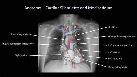 How to Interpret a Chest X-Ray (Lesson 2 - A Systematic Method and Anatomy) | X ray, Anatomy ...