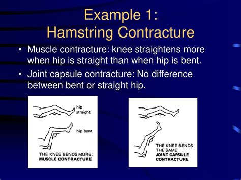 Contractures and Positioning - ppt download