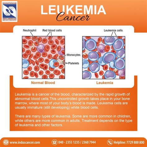 Comprehensive Guide to Leukemia: Symptoms, Causes, Treatment, Types ...