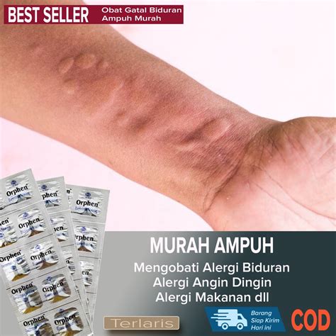 Jual Obat gatal Biduran MURAH AMPUH mengobati Gatal Alergi Cuaca Alergi ...