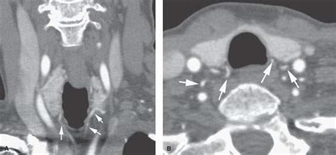 Hypopharynx: Introduction, Normal Anatomy, and Function | Radiology Key