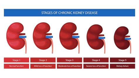 Understanding the Stages of Chronic Kidney Disease (CKD)