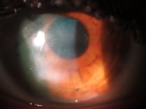 Corneal Scarring | CLI Nevada