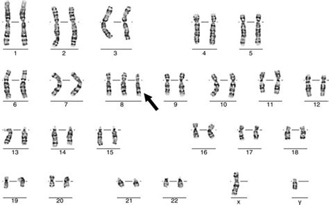 Trisomy 8 . mosaic syndrome | Vinmec