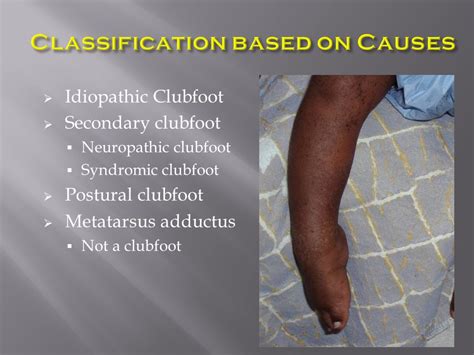 Metatarsus Adductus Vs Clubfoot