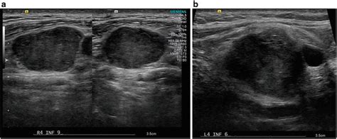 Abnormal Cervical Lymph Node Ultrasound