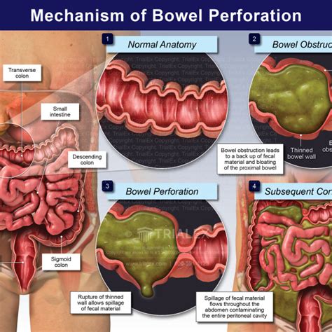 Mechanism of Bowel Perforation Caucasian Male - TrialExhibits Inc.