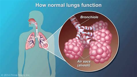 Understanding COPD - YouTube