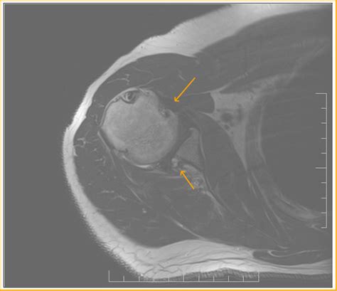 Reverse Hill Sachs Lesion: MRI - Sumer's Radiology Blog