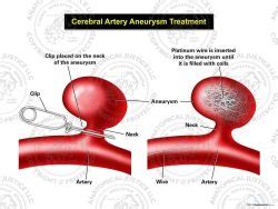 Right Internal Carotid Artery Aneurysm Illustration | Anatomical Justice