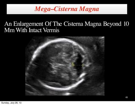 cerebellar and cisterna magna on ultrasound | Fetal, Ultrasound, Diagnostic medical sonography