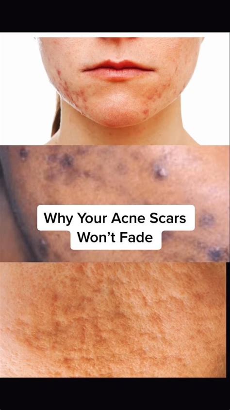 How to fade acne scars – Artofit