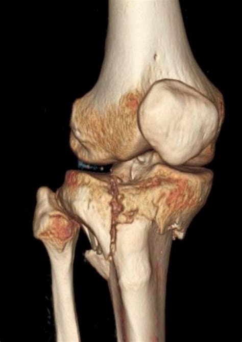 14.9: Knee Trauma – Acute Fractures - Medicine LibreTexts