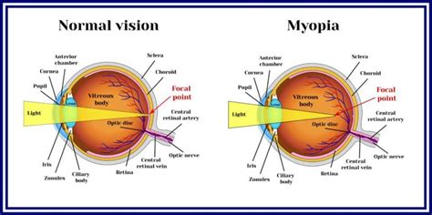 The Best Glasses & Lenses Options for Nearsightedness – NVISION