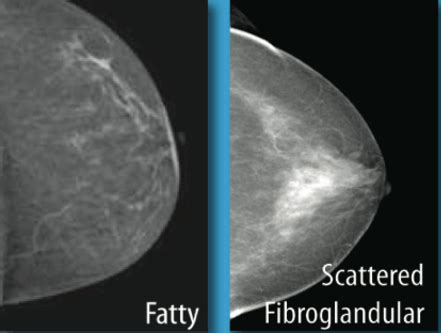 What does Scattered Fibroglandular Densities Mean? | Dentgap