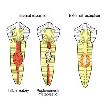 Tooth Resorption | NW Endodontics | Dr. Eric C.K. Law