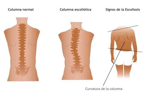 Mi Vida Con Escoliosis: Escoliosis Lumbar: Síntomas y tratamientos.