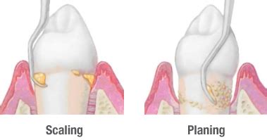 Scaling and Root Planing | Carrollton Advanced Family Dentistry