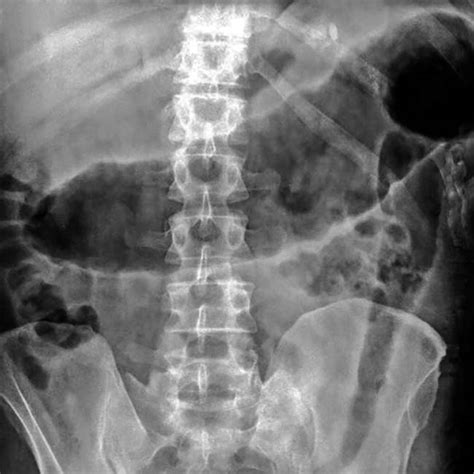 EM Didactic: Ulcerative Colitis - ED Management