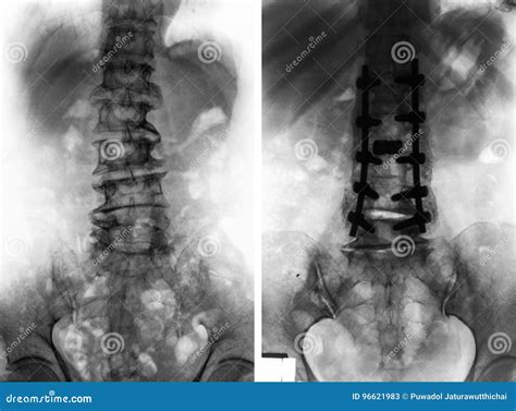 Spondylosis . before and after Surgery . Stock Image - Image of bone ...