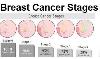 What Are The 4 Stages Of Breast Cancer, Instruction | by Farrukh Siddique | Medium