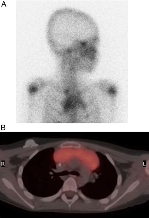 Gallium and positron emission tomography (PET) scans. (A) Increased... | Download Scientific Diagram