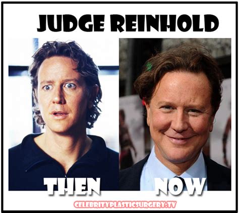 Judge Reinhold Plastic Surgery Before and After Facelift, Botox and Cheek filler | Plastic Surgery