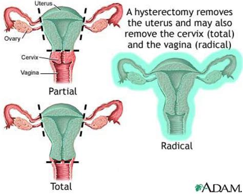 【hysterectomy】什么意思_英语hysterectomy的翻译_音标_读音_用法_例句_在线翻译_有道词典