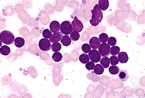 Precusor B-cell Acute Lymphoblastic Leukemia - 2.