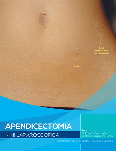 Apendicectomia mini laparoscopica by Luis Godoy - Issuu