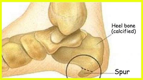 Heel Spurs: Symptoms and Treatment - YouTube