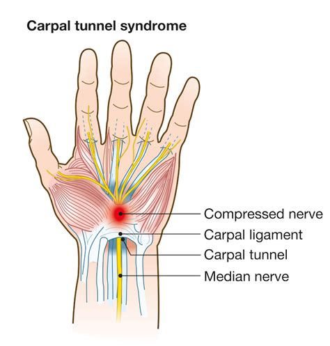 What causes carpal tunnel syndrome? | Catching Health with Diane Atwood