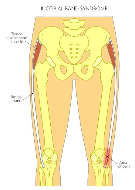 What Causes Lateral Knee Pain?