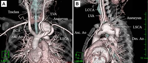 Repair of Tortuous Distal Aortic Arch Aneurysm in a 1-Year-Old Girl ...