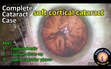 Complete Case: Cortical Cataract – Cataract Coach