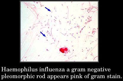 Haemophilus Influenza Gram Stain