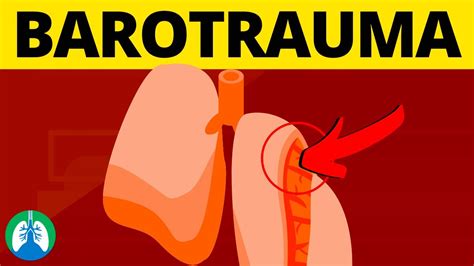 Pulmonary Barotrauma (Medical Definition) | Quick Explainer Video - YouTube