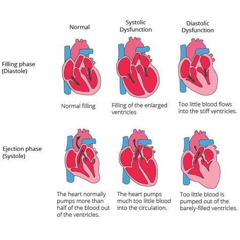 Stages Of Heart Failure Chart