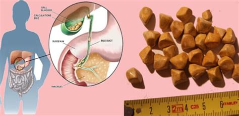 Gallstones- Symptom, Causes, Type, Risk Factors And Complications