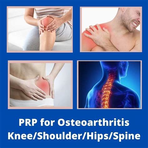 PRP for Osteoarthritis Knee/Shoulder/Hips/Spine - PRP Treatment center